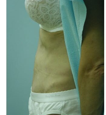 After Image: Abdominoplasty - left-side