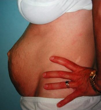 Before Image: Abdominoplasty - left-side
