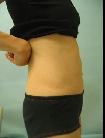 After Image: Abdominoplasty - right-side