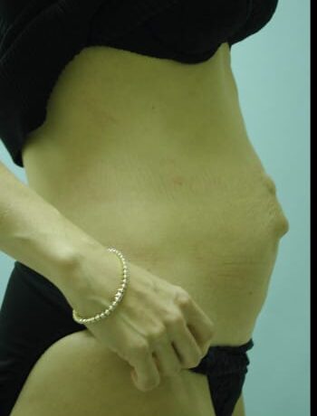 Before Image: Abdominoplasty - right-side