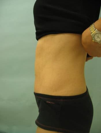After Image: Abdominoplasty - left-side