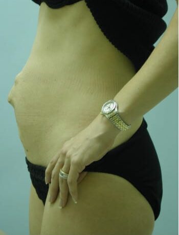 Before Image: Abdominoplasty - left-side