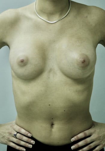 After Image: Breast Augmentation - front