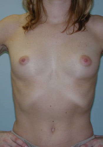 Before Image: Breast Augmentation - front
