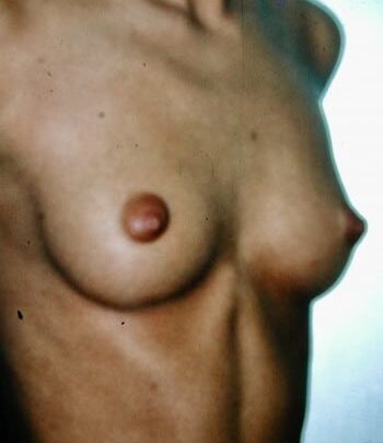 Before Image: Breast Augmentation - right-front-oblique