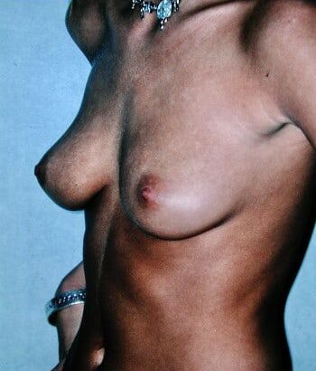 Before Image: Breast Augmentation - left-front-oblique