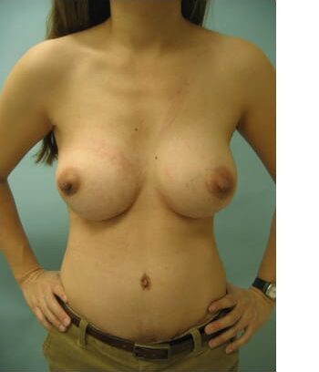 After Image: Abdominoplasty, Breast Augmentation - front