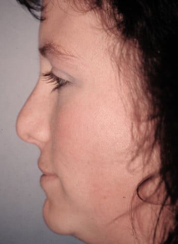 After Image: Abbe Flap - front