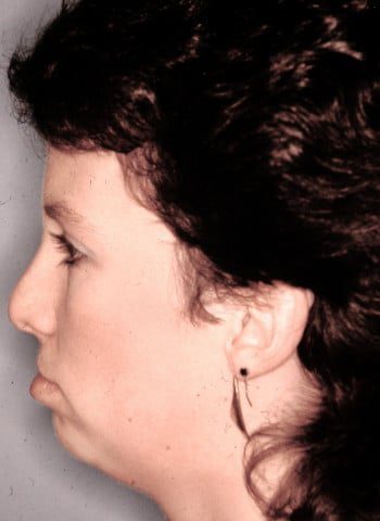 Before Image: Abbe Flap - front