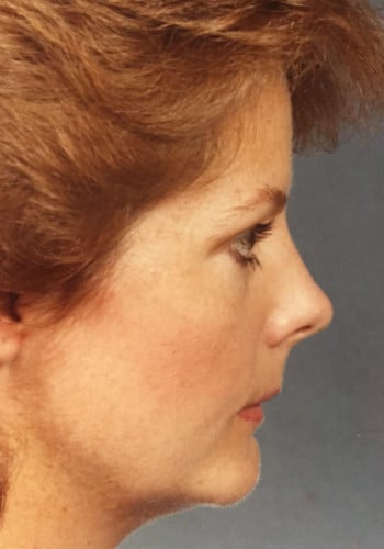 After Image: Genioplasty - right-side