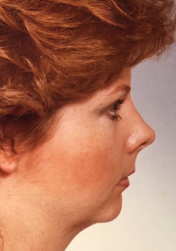 Before Image: Genioplasty - right-side
