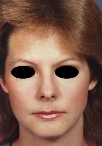 After Image: Genioplasty - front