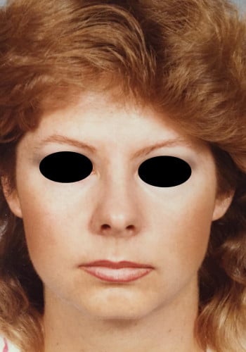 Before Image: Genioplasty - front