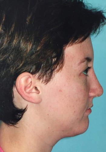 After Image: Genioplasty, Rhinoplasty - right-side