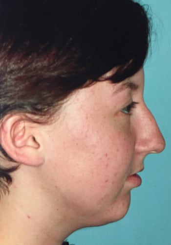 Before Image: Genioplasty, Rhinoplasty - right-side