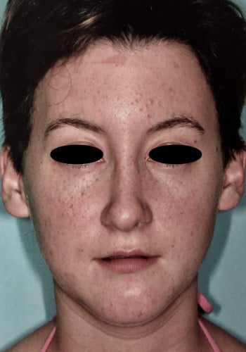 After Image: Genioplasty, Rhinoplasty - front
