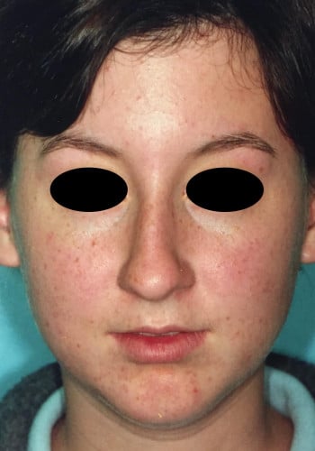 Before Image: Genioplasty, Rhinoplasty - front