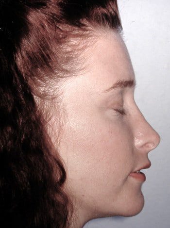 After Image: Genioplasty - right-side
