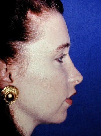 Before Image: Genioplasty - right-side