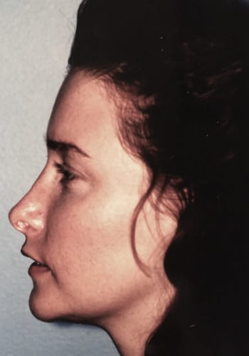 After Image: Genioplasty - left-side
