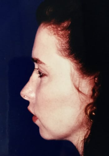 Before Image: Genioplasty - left-side