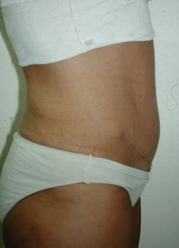 After Image: Abdominoplasty - right-side