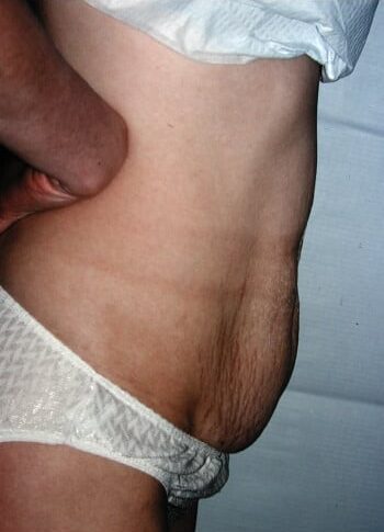 Before Image: Abdominoplasty - right-side