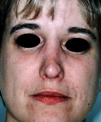 After Image: Rhinoplasty - front