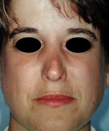 Before Image: Rhinoplasty - front