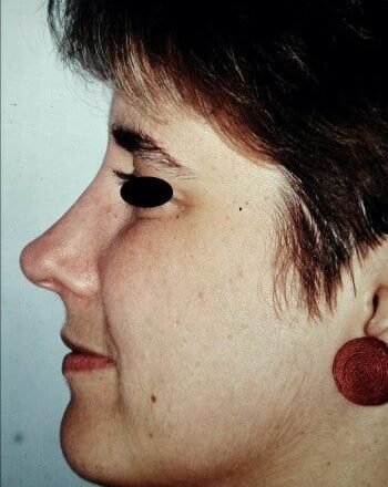 After Image: Rhinoplasty - left-side