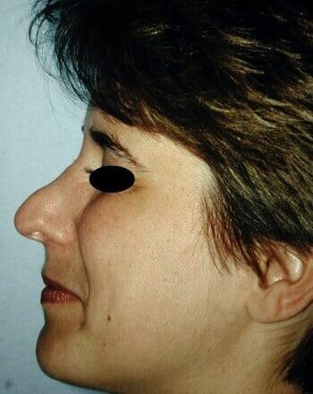 Before Image: Rhinoplasty - left-side