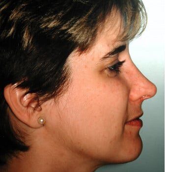 After Image: Rhinoplasty - right-side