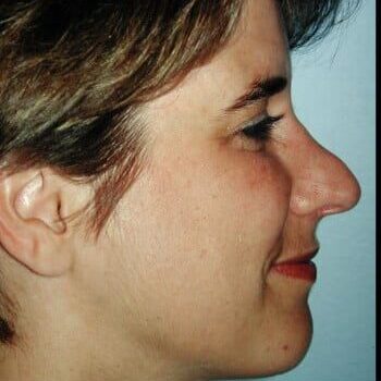 Before Image: Rhinoplasty - right-side