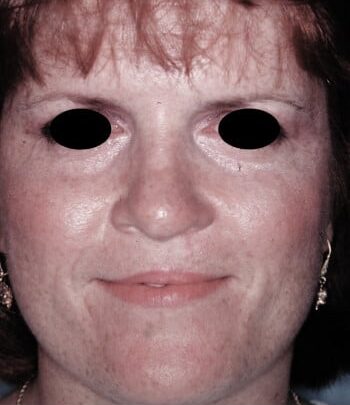 After Image: Cleft Rhinoplasty - front