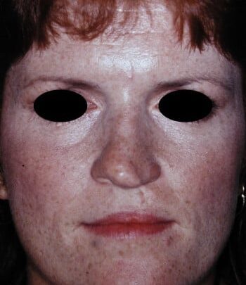Before Image: Cleft Rhinoplasty - front
