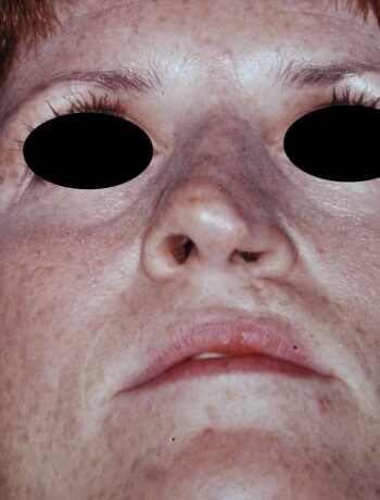 Before Image: Cleft Rhinoplasty - front