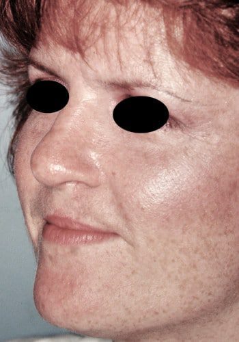 After Image: Cleft Rhinoplasty - left-front-oblique