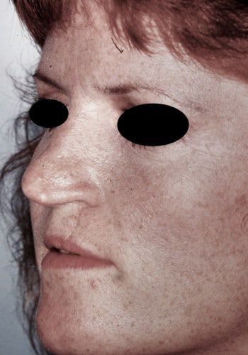 Before Image: Cleft Rhinoplasty - left-front-oblique