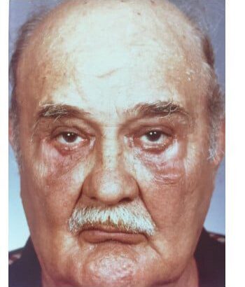 After Image: Blepharoplasty - front