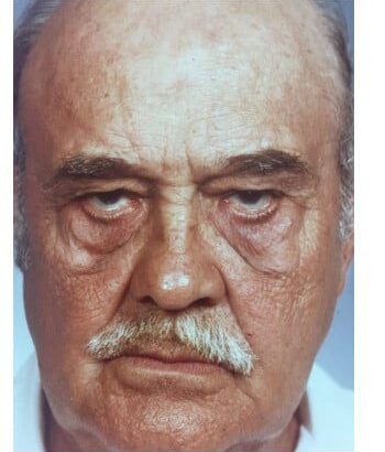 Before Image: Blepharoplasty - front