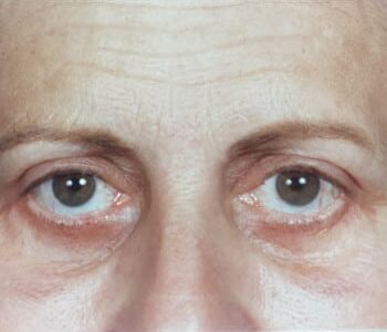 After Image: Blepharoplasty - front