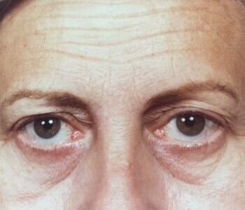 Before Image: Blepharoplasty - front