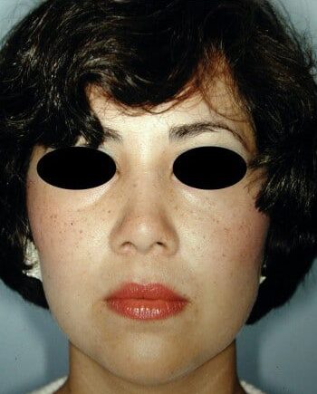After Image: Rhinoplasty - front