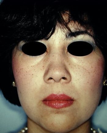 Before Image: Rhinoplasty - front