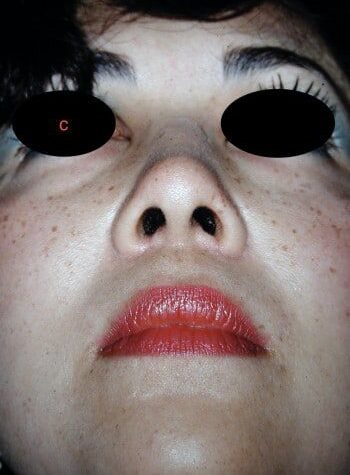 After Image: Rhinoplasty - front