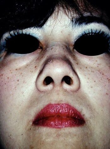 Before Image: Rhinoplasty - front