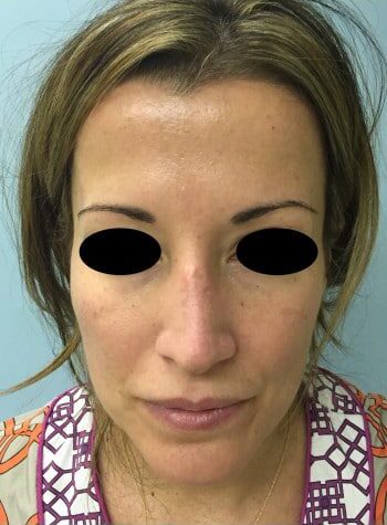 After Image: Rhinoplasty - front
