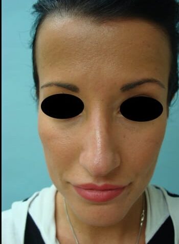 Before Image: Rhinoplasty - front