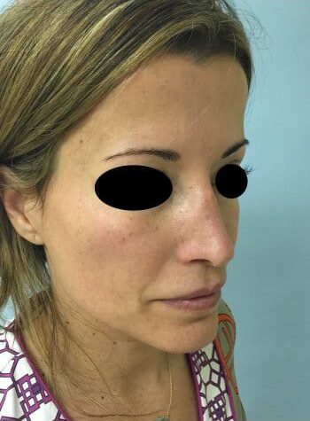After Image: Rhinoplasty - right-front-oblique