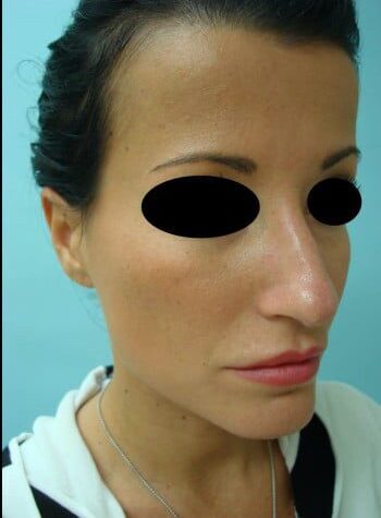 Before Image: Rhinoplasty - right-front-oblique